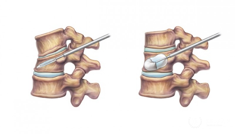 Кифопластика – особенности проведения, результаты операции