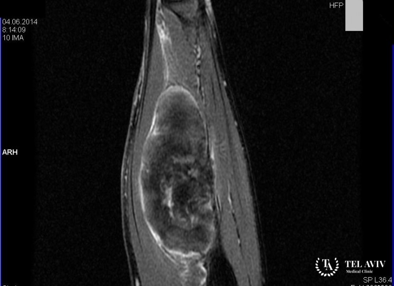 Опухоли периферических нервов