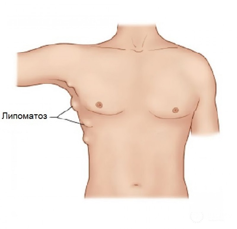 Липома переферических нервов