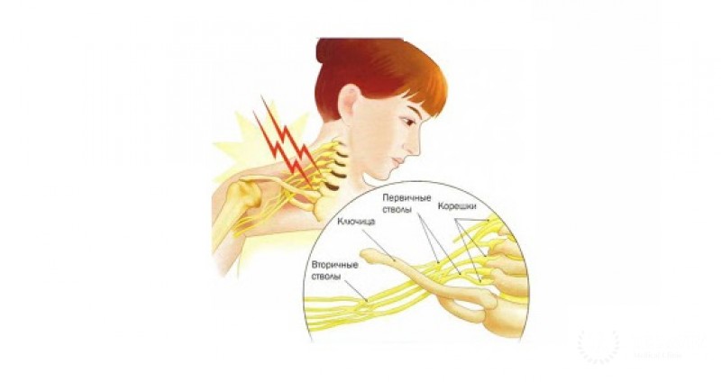 Повреждение нервов плечевого сплетения