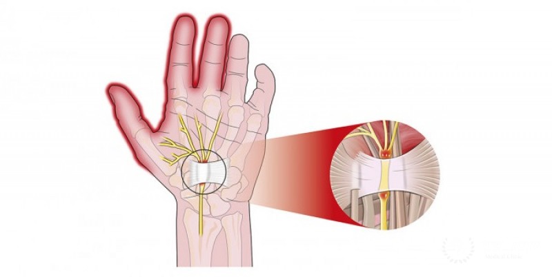 Повреждение периферических нервов