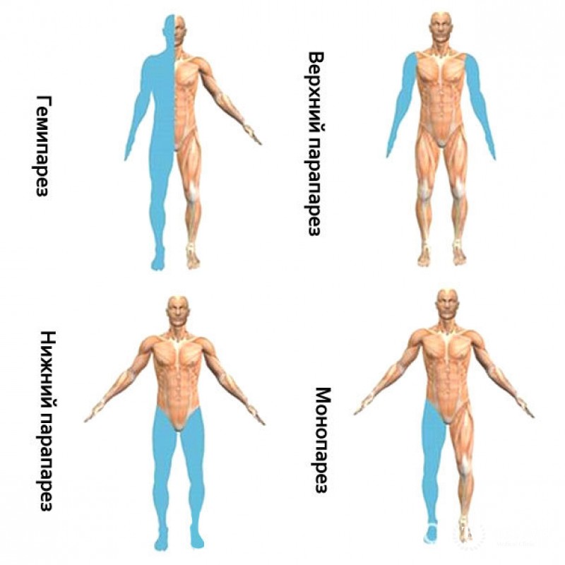 Частичный или полный паралич верхней либо нижней конечности