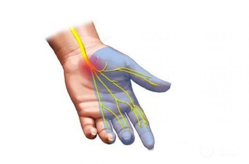 Парестезия