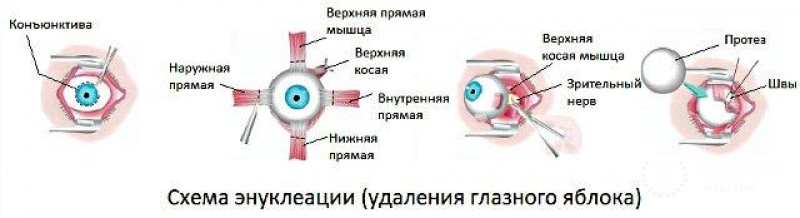 Энуклеация - полная информация