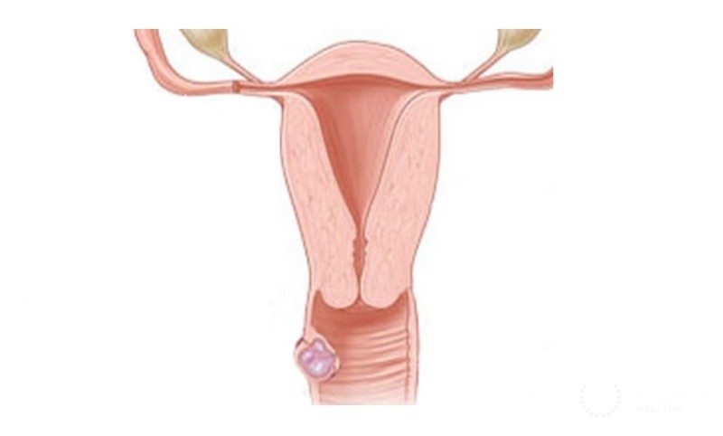 Киста влагалища - диагностика и лечение