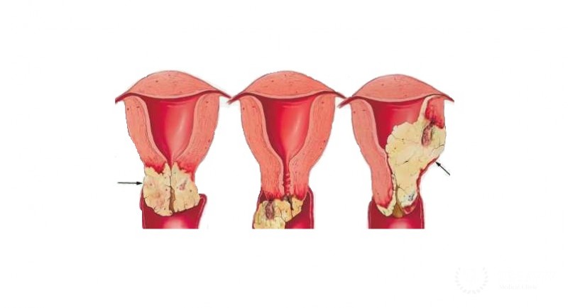 Вагинэктомия – виды операций, реабилитация