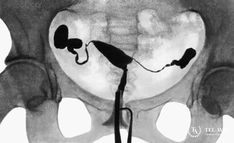 Гистеросальпингография (ГСГ) маточных труб