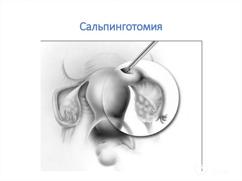 Сальпинготомия