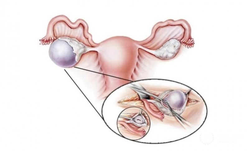 Односторонняя овариэктомия