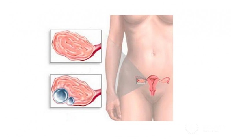 Эндометриоидная киста яичника