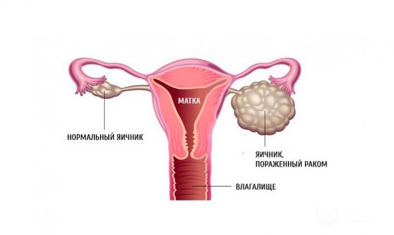 Гонадобластомы яичника