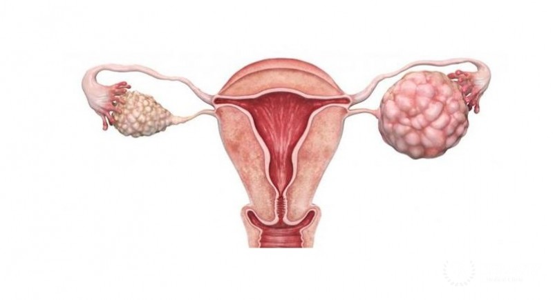 Светлоклеточный (мезонефроидный) рак яичника