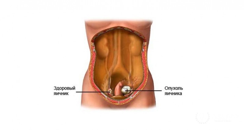 Семинома яичника