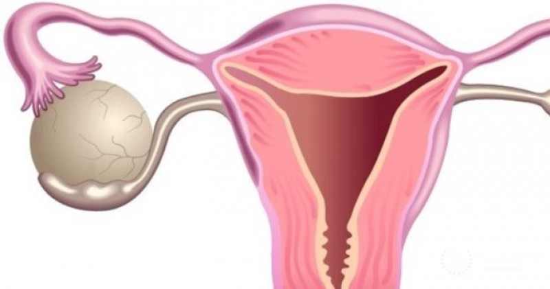 Опухоль Бреннера