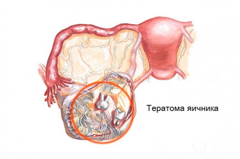 Тератома яичника