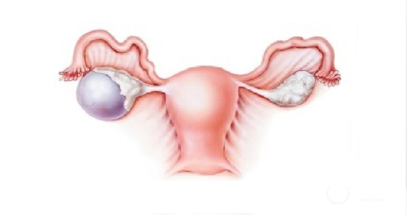 Фиброма яичника