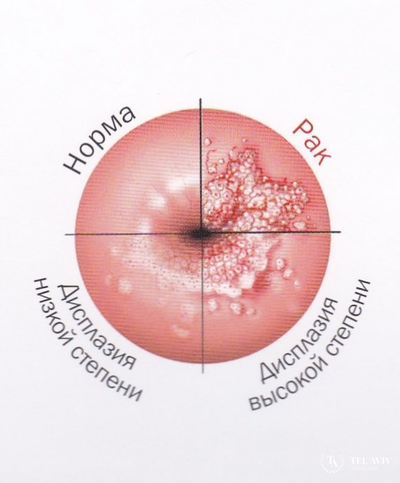 Вульварная интраэпителиальная неоплазия