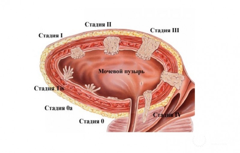 Переходно-клеточная карцинома (уротелиальная карцинома) - вся информация
