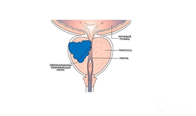 Аденокарцинома уретры - вся информация