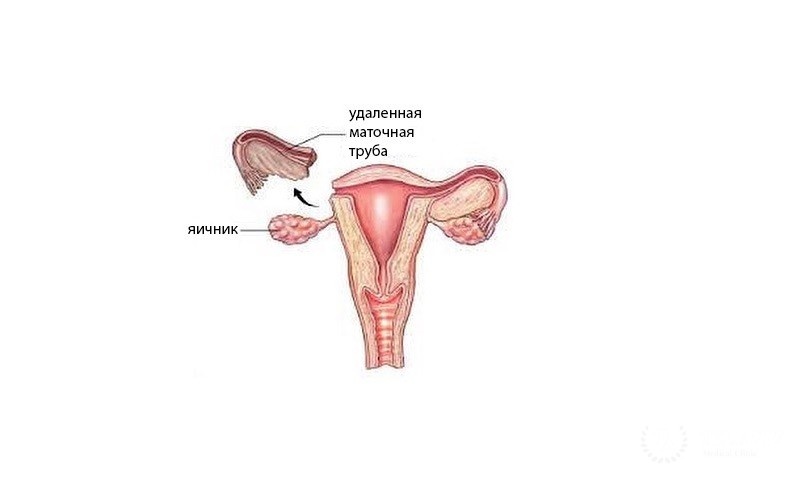Сальпингэктомия
