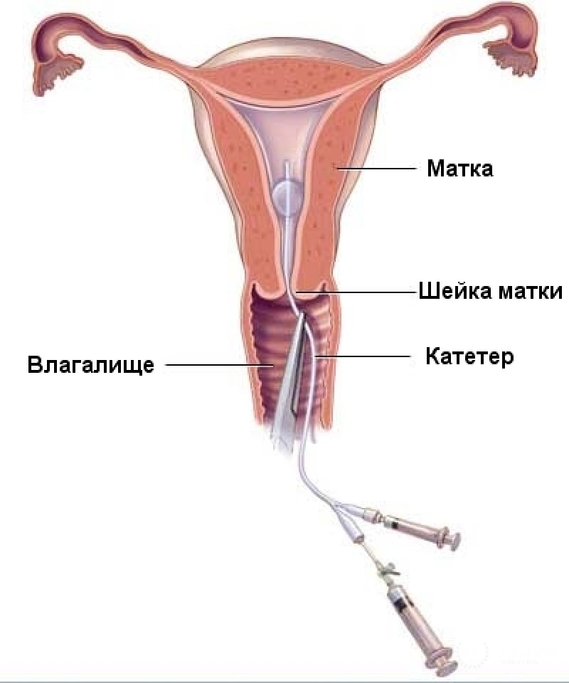 УЗИ-диагностика (эхогистеросальпингография)