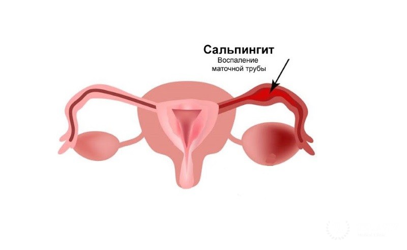 Хронический сальпингит