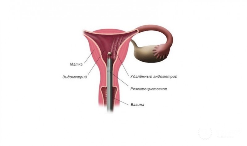 Абляция эндометрия матки
