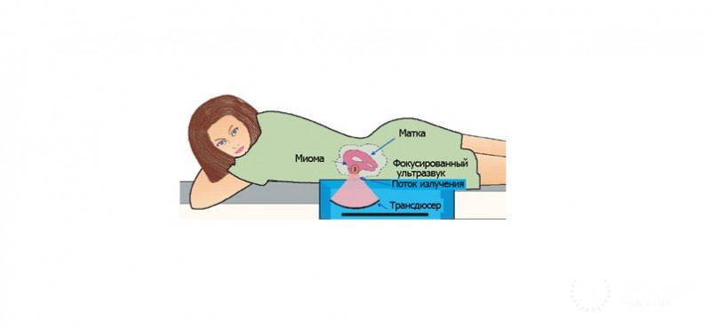 ФУЗ абляция миомы матки под контролем МРТ (ФУЗ-МРТ)