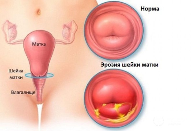 Эрозия шейки матки