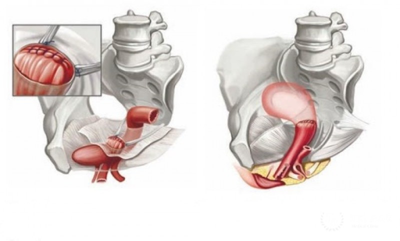 Крестцово-остистая фиксация