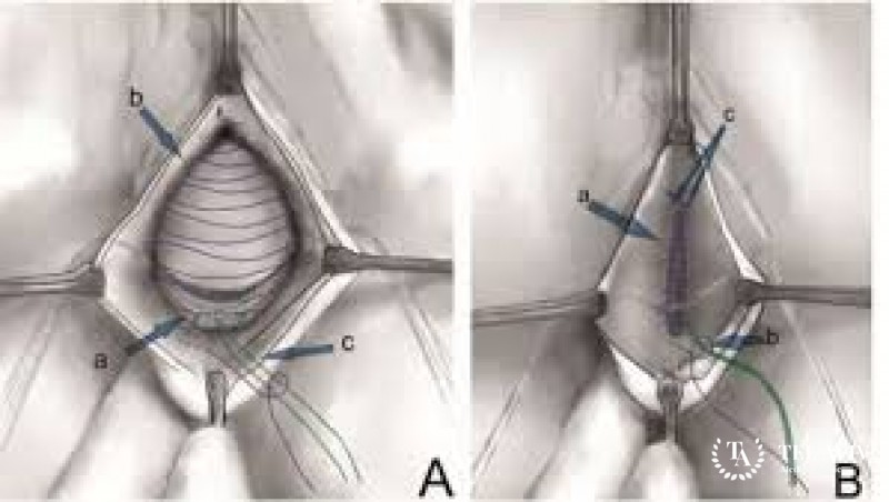 Гибридная реконструкция тазового дна