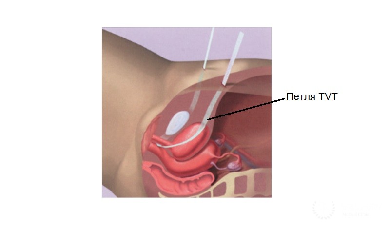 Новый метод TVT (Tension-free Vaginal Tape, Свободная синтетическая петля)