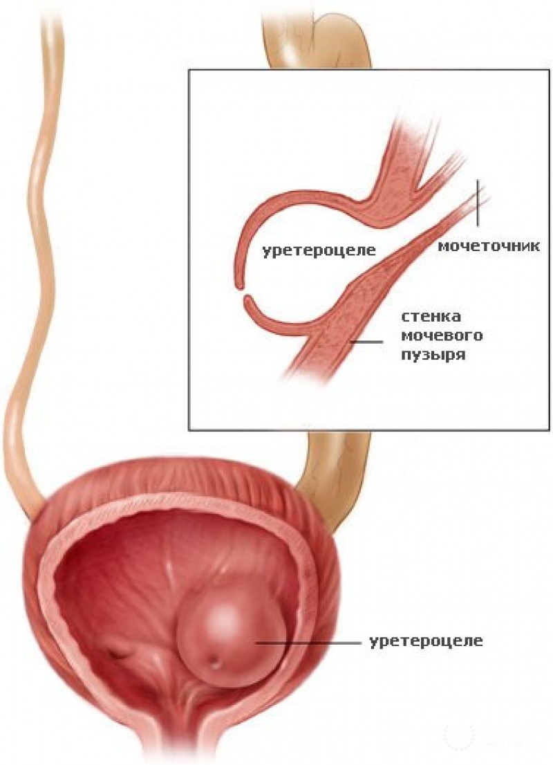Уретроцеле