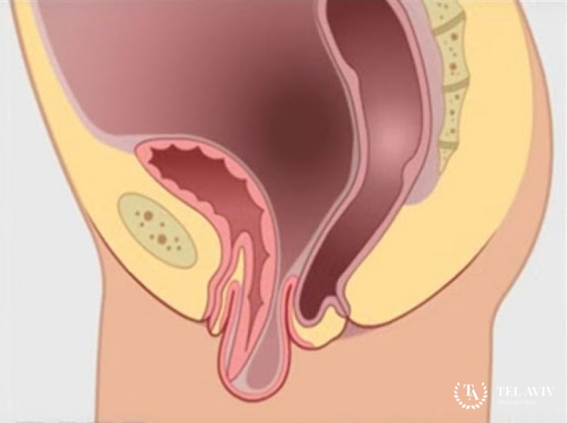 Выпадение купола влагалища