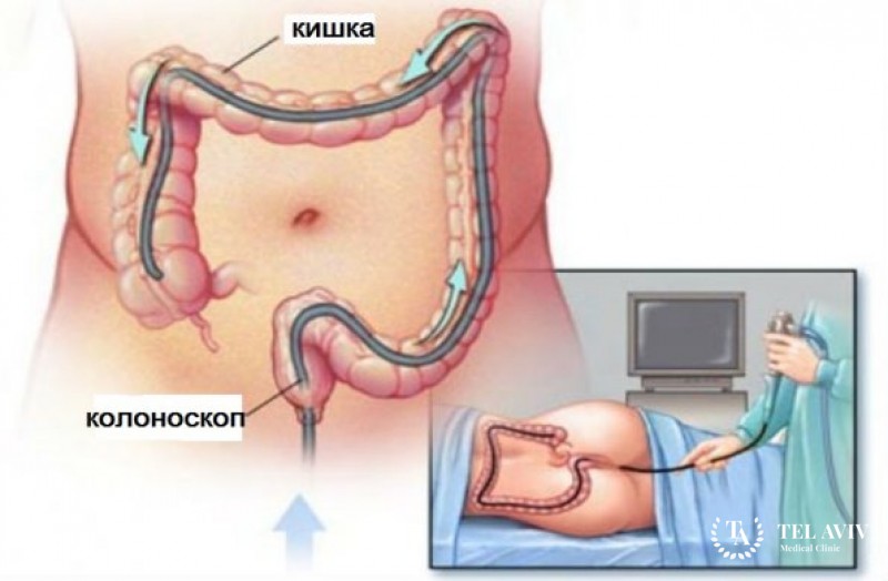 Фиброколоноскопия