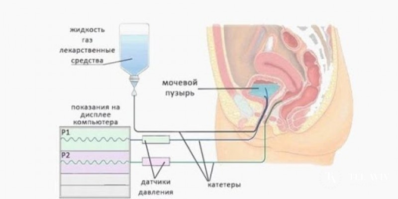Цистометрия наполнения