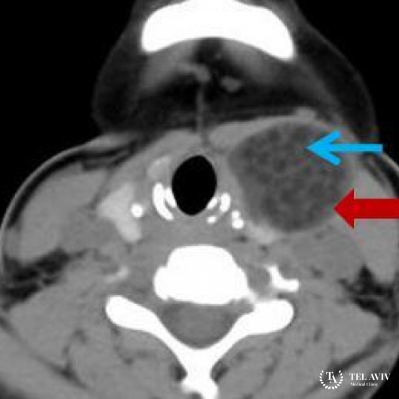 Дермоидная киста в области шеи у детей