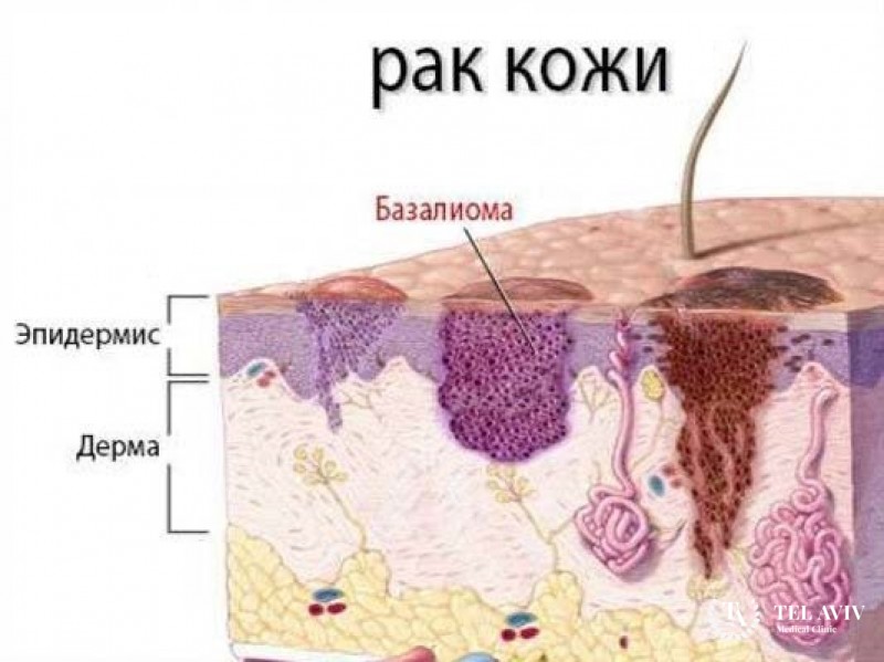 Базалиома у ребенка