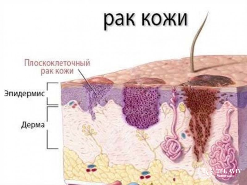 Плоскоклеточный рак кожи