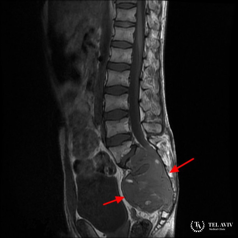 Хордома у ребенка