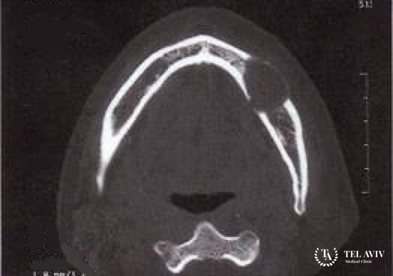 Меланотическая прогонома (меланотическая нейроэктодермальная опухоль у детей)