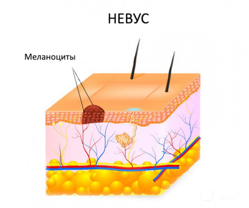 Ювенильные и врождённые невусы