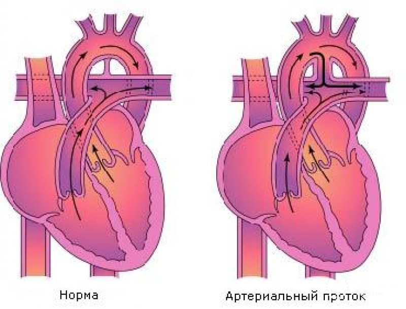 Дефект межжелудочковой перегородки и открытый артериальный проток