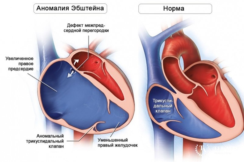 Аномалия Эбштейна - вся информация