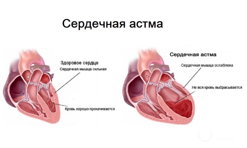 Сердечная астма - вся информация