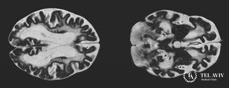 Глутарацидурия тип I