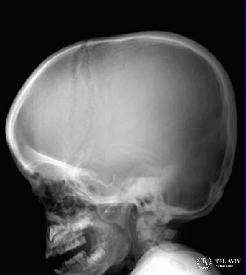 Мукополисахаридоз