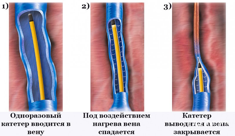 Радиочастотная абляция