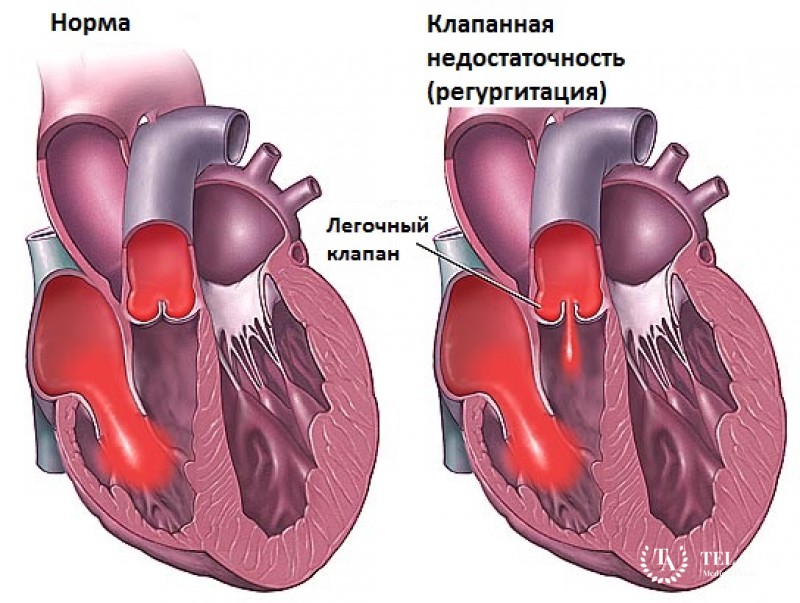 Трансплантация гомографта легочного клапана