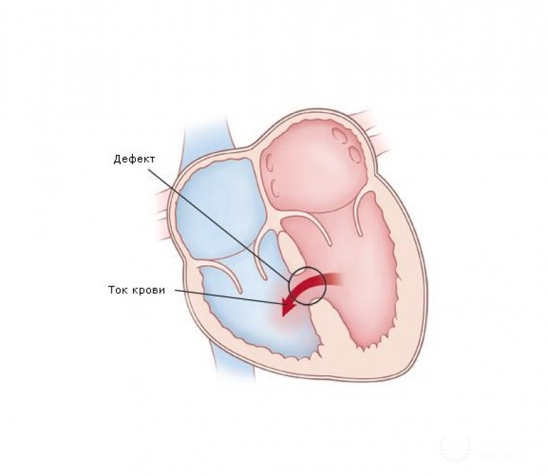 Коррекция дефектов межжелудочковой перегородки